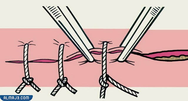 حجم غرز الولادة الطبيعية