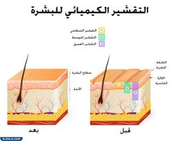 خامسًا إزالة الخطوط البيضاء من الجسم بطريقة التقشير