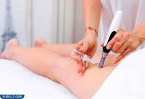 سادسًا إزالة الخطوط البيضاء من الجسم عن طريق الوخز بالإبر