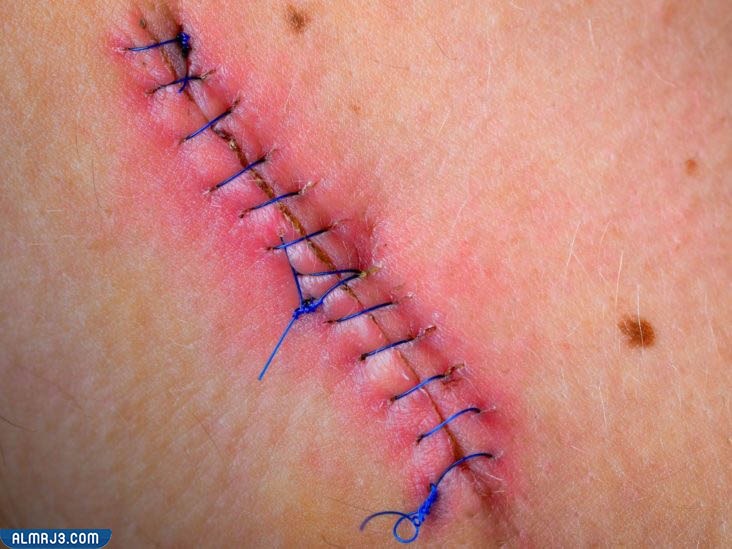 شرح مصطلح غرز الولادة الطبيعية