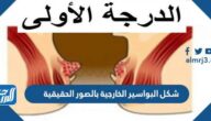 شكل البواسير الخارجية بالصور الحقيقية