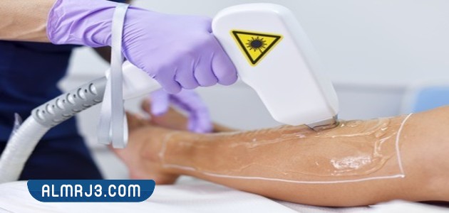 علاج آثار حروق الليزر