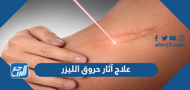 علاج آثار حروق الليزر