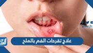 علاج تقرحات الفم بالملح