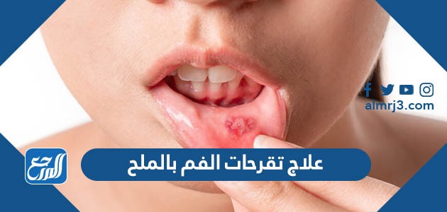 علاج تقرحات الفم بالملح