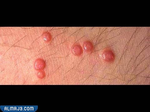 علاج حبوب المهبل من الداخل