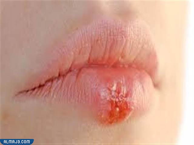 علاج حبوب الهربس حول الفم