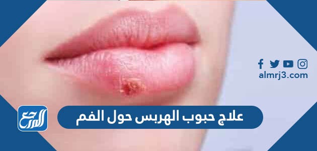 علاج حبوب الهربس حول الفم