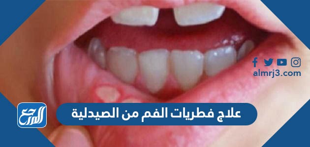 علاج فطريات الفم من الصيدلية