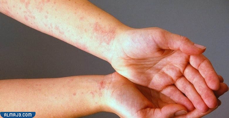 علامات الشفاء من الجرب