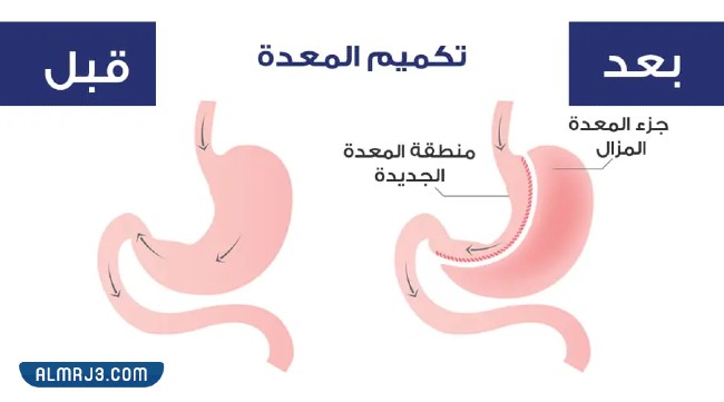 عملية تكميم المعدة