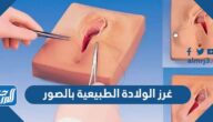 غرز الولادة الطبيعية بالصور