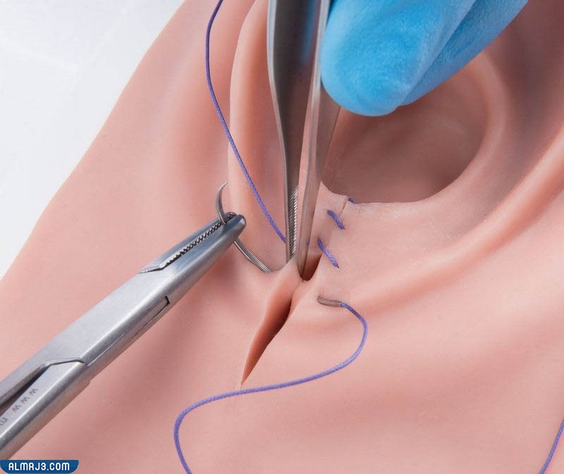 غرز الولادة الطبيعية بين المهبل والعجان