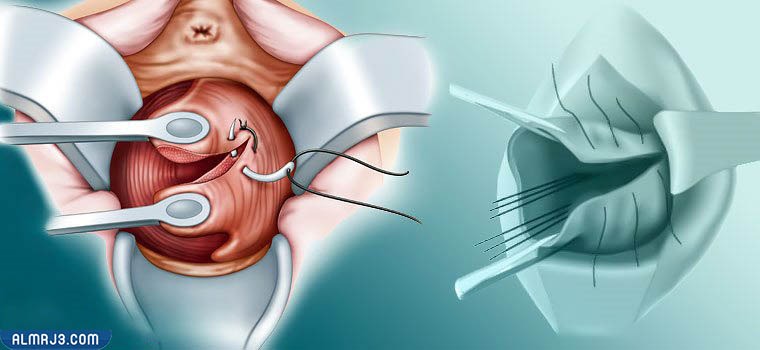غرز الولادة الطبيعية بين المهبل وفتحة الشرج