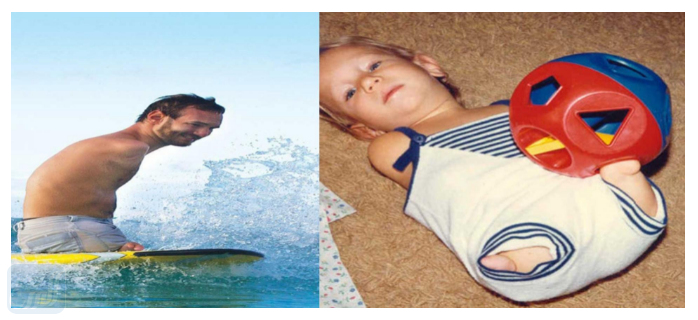 قصة عن اليوم العالمي لذوي الاحتياجات الخاصة