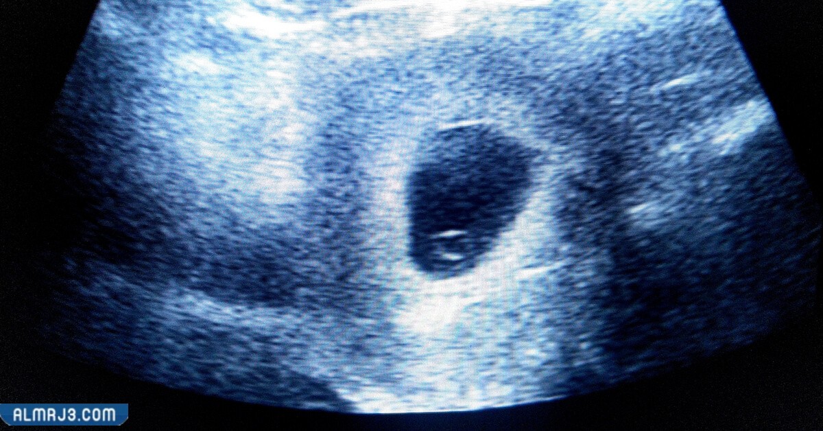 كيس الجنين