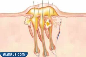 كيفية تشكل الدمامل والخراج