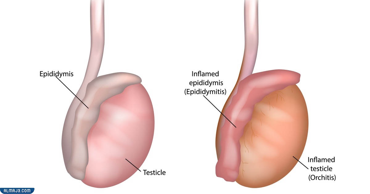 ما هو التهاب البربخ؟