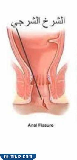 ما هو الشق الشرجي