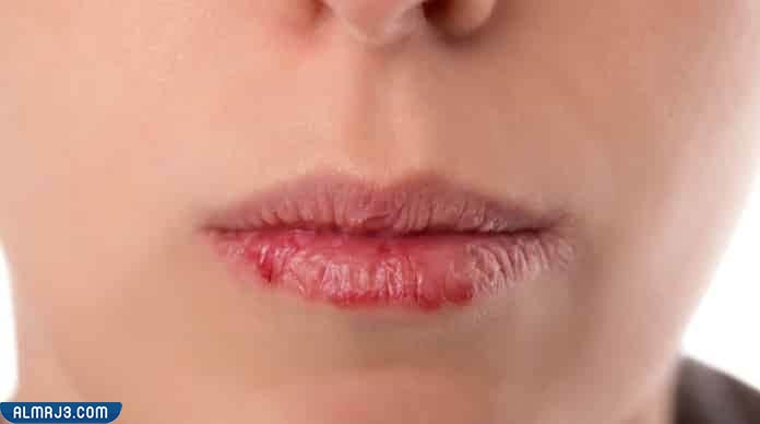 ما هو الهربس الفموي