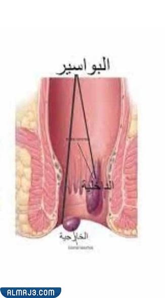 ما هي البواسير