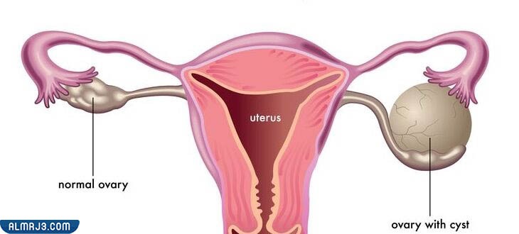 ماهية أكياس المبيض