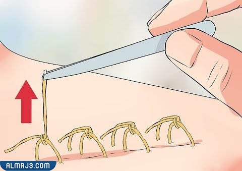 متى تسقط غرز الولادة