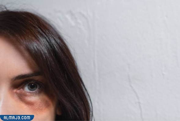 مخاطر عملية شد الجفون