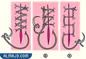 نصائح للعناية بجرح وغرز الولادة الطبيعية