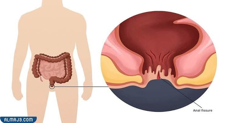 تجربتي في علاج الشرخ بالفازلين