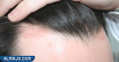 أسباب الإصابة بالأمراض الجلدية التي تصيب فروة الرأس