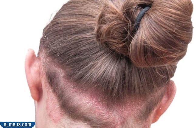 طرق الوقاية من الأمراض الجلدية التي تصيب فروة الرأس