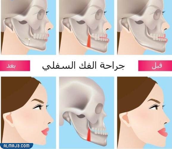 Lower jaw surgery before and after