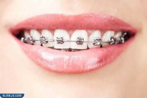 تقويم الأسنان المعدني التقليدي