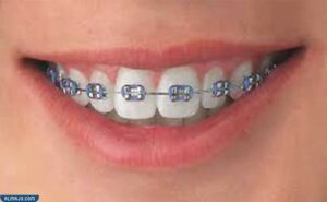 تقويم الأسنان المعدني التقليدي