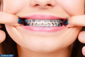 تقويم الأسنان المعدني التقليدي