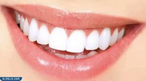 انواع تقويم الاسنان بالصور