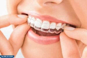 تقويم الأسنان الشفاف