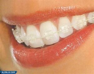 تقويم الأسنان الخزفي