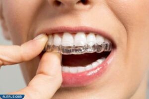 تقويم الأسنان الشفاف