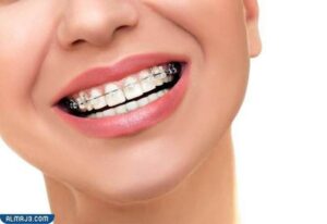 تقويم الأسنان الخزفي