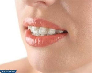 تقويم الأسنان الخزفي