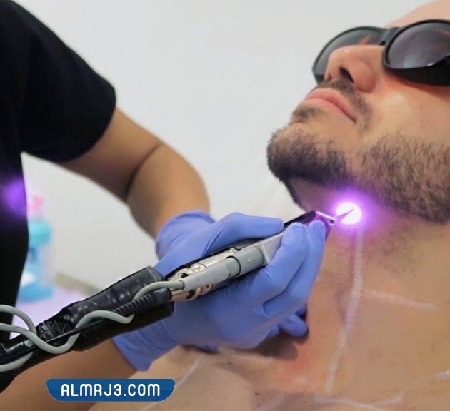 إزالة الشعر بالليزر للرجال