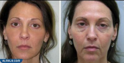 التجربة الأولى التخلص من الخطوط التعبيرية وتجاعيد العينين