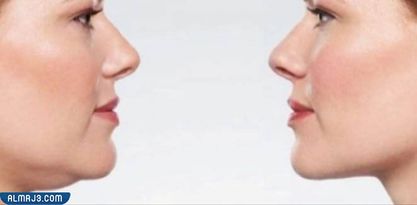 التجربة الرابعة تجديد الذقن مع التخلص من الجلد الميت عن طريق استخدام جهاز الألثيرا