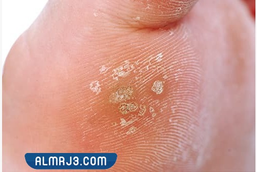 الثالول الأخمصي بالصور