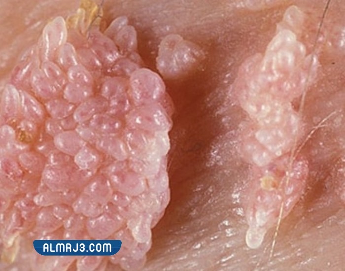 الثالول التناسلي بالصور