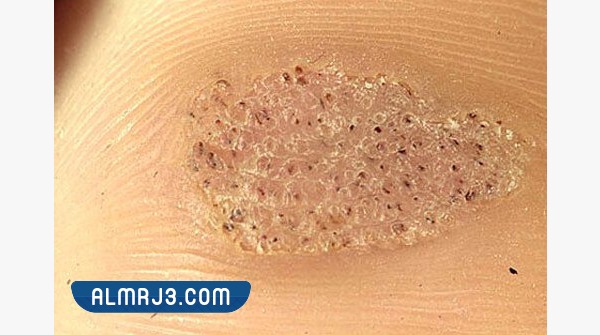 الثالول الفسيفسائي بالصور