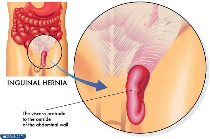الفتق الإربي