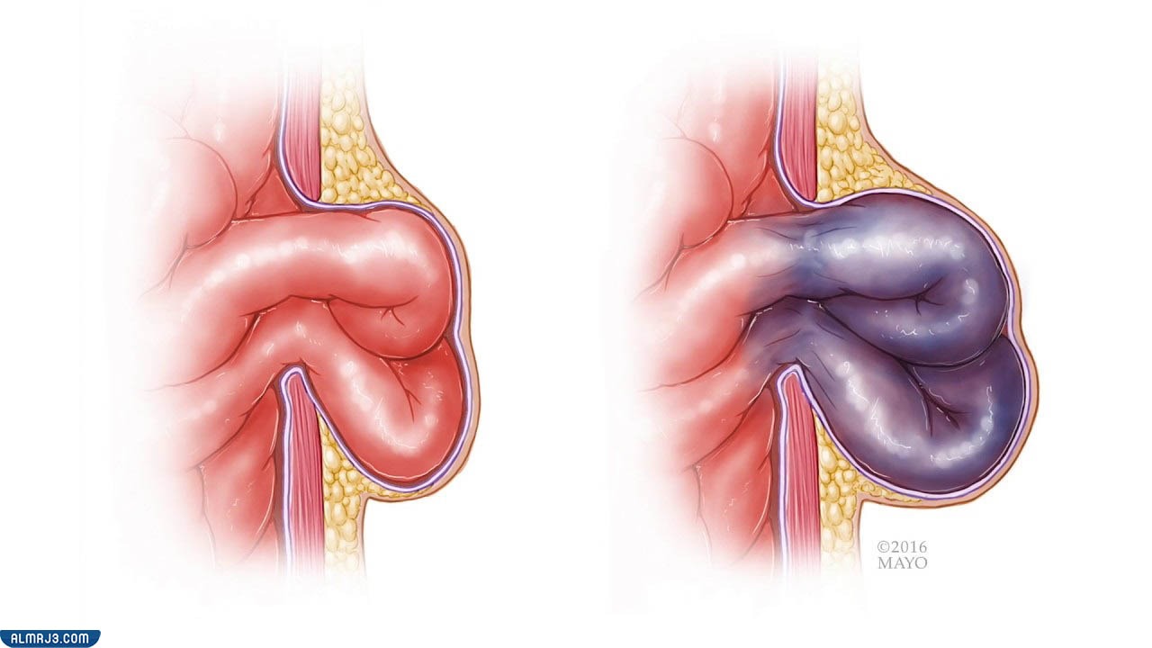 الفتق المحبوس